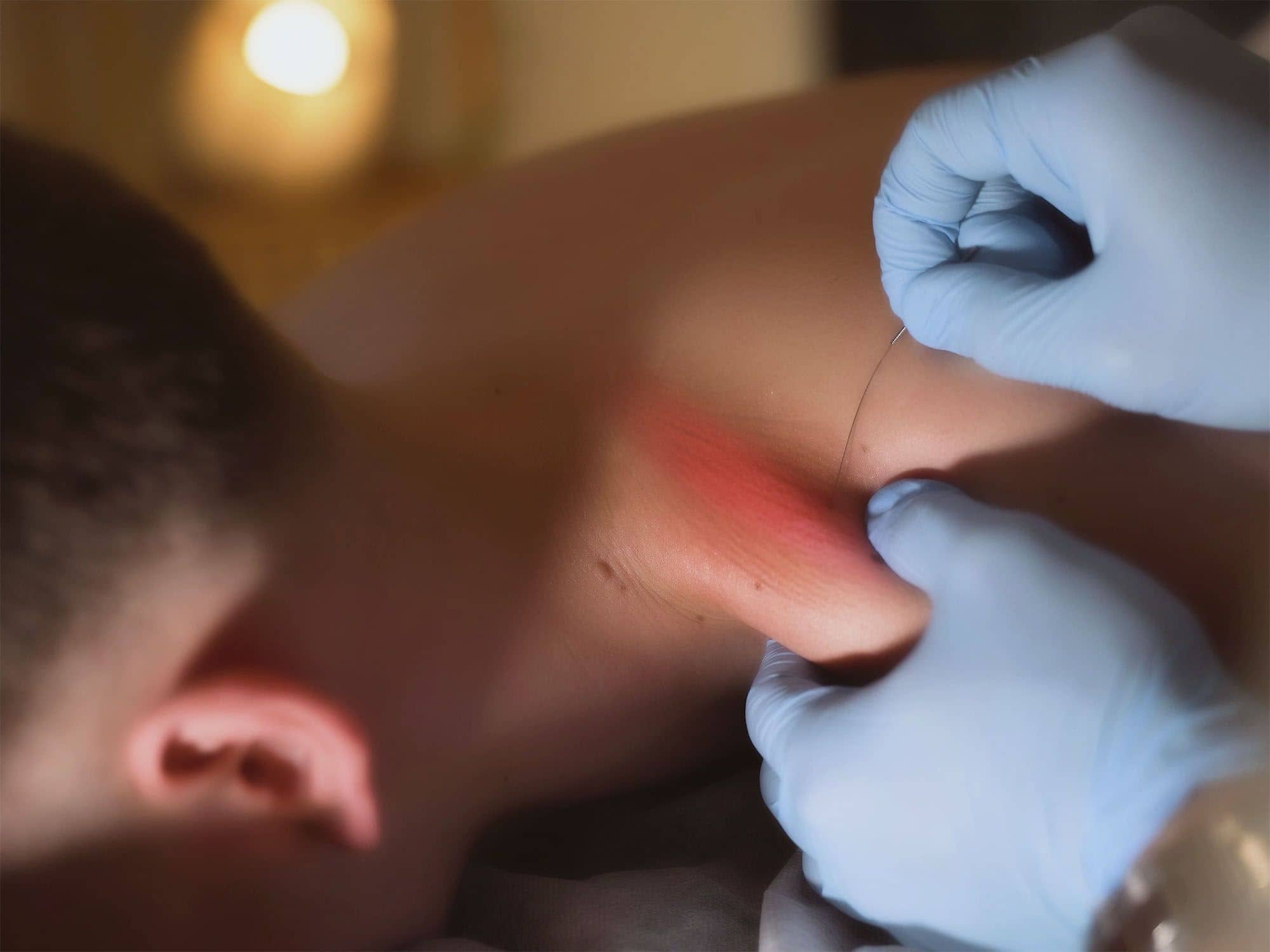 dry needling
