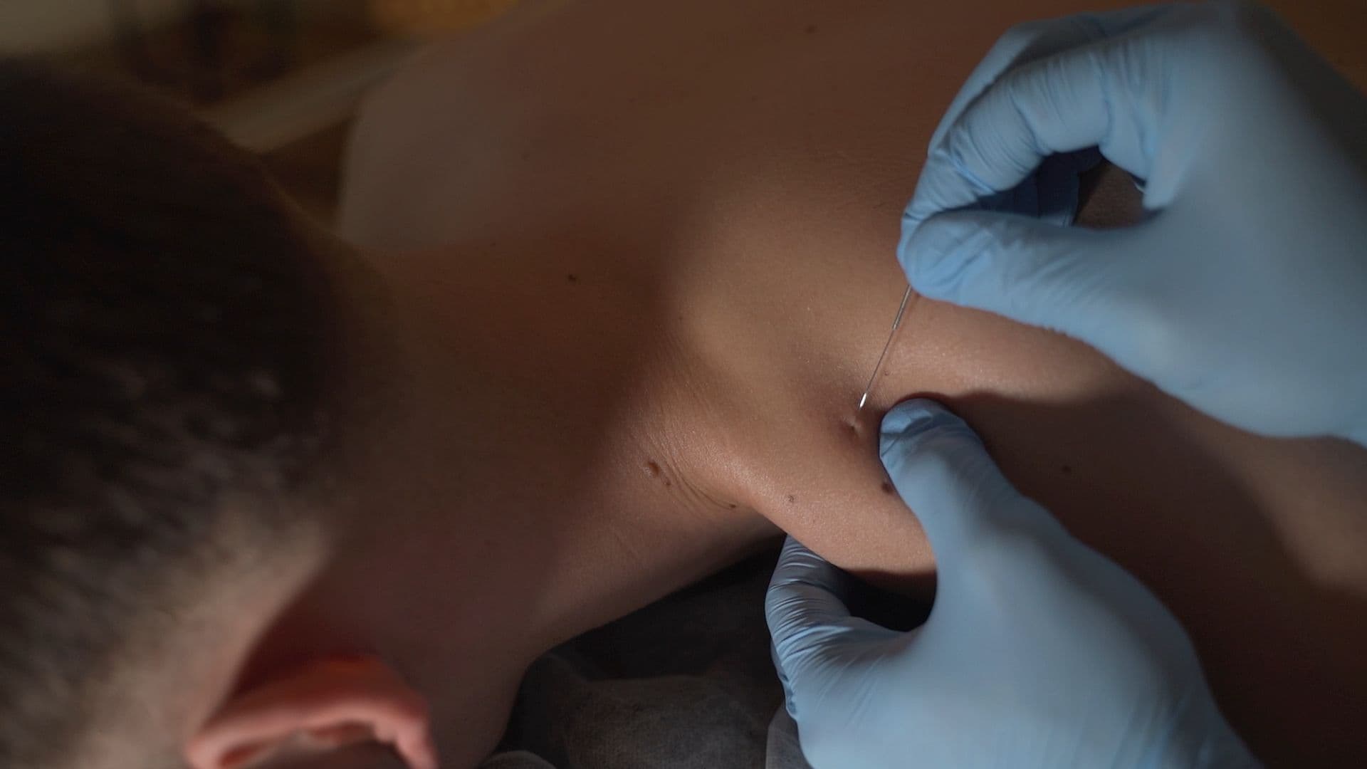 Dry needling la domiciliu